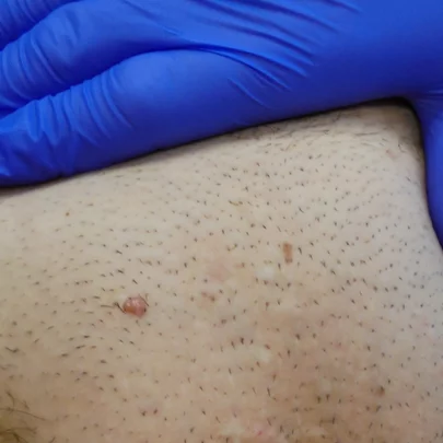 KLINICKÝ OBRAZ KLINICKÝ OBRAZ
